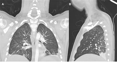 Efficacy of sildenafil and high-dose anakinra in an MIS-C patient with pulmonary vasculitis: A case report